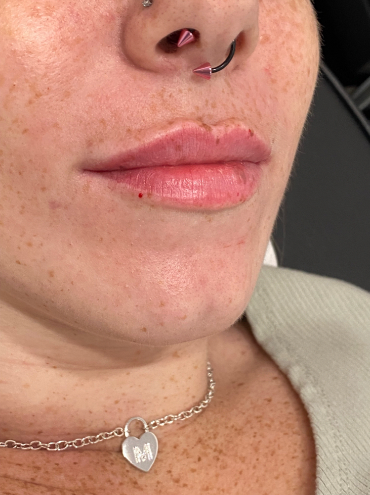 Filler at Aesthetic NP Marie in Portland, OR