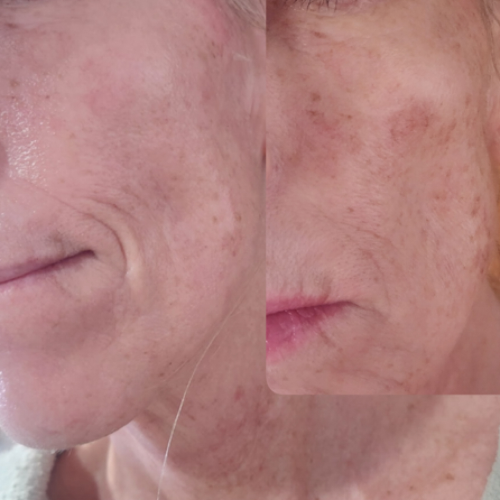 Xo Chemical Peel at Beautiqueen in Valparaiso, IN