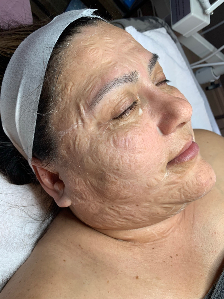 Facelift Facial