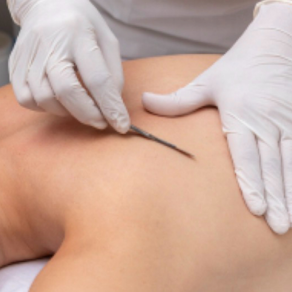 Back Dermaplane - Add On at The Bubble                                     Aesthetics and Spa in Soddy Daisy, TN