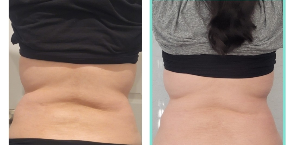Cavitation (Large Area)