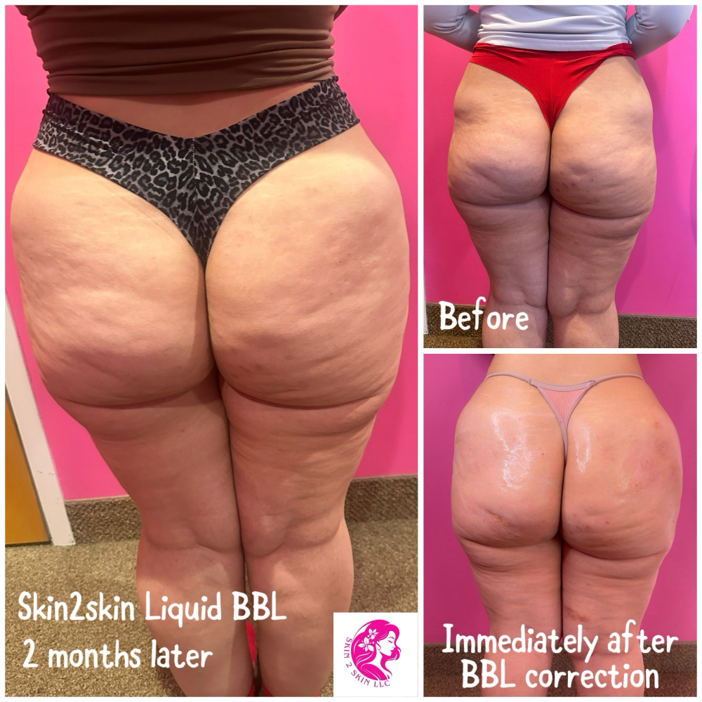 🍑 Liquid BBL & Hip Augmentation