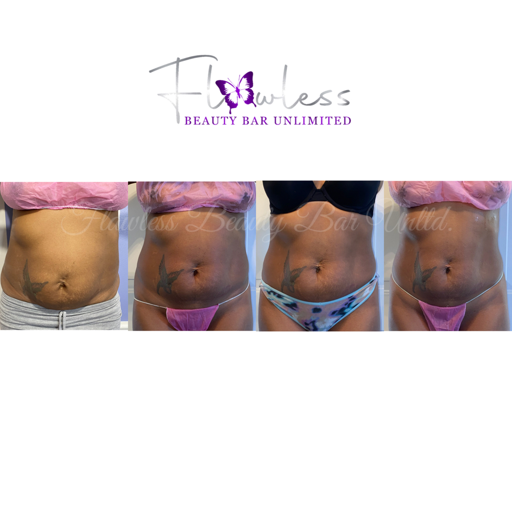 Body Cavitation