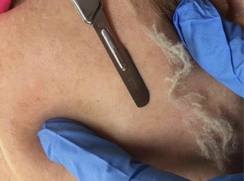 Dermaplaning Facial