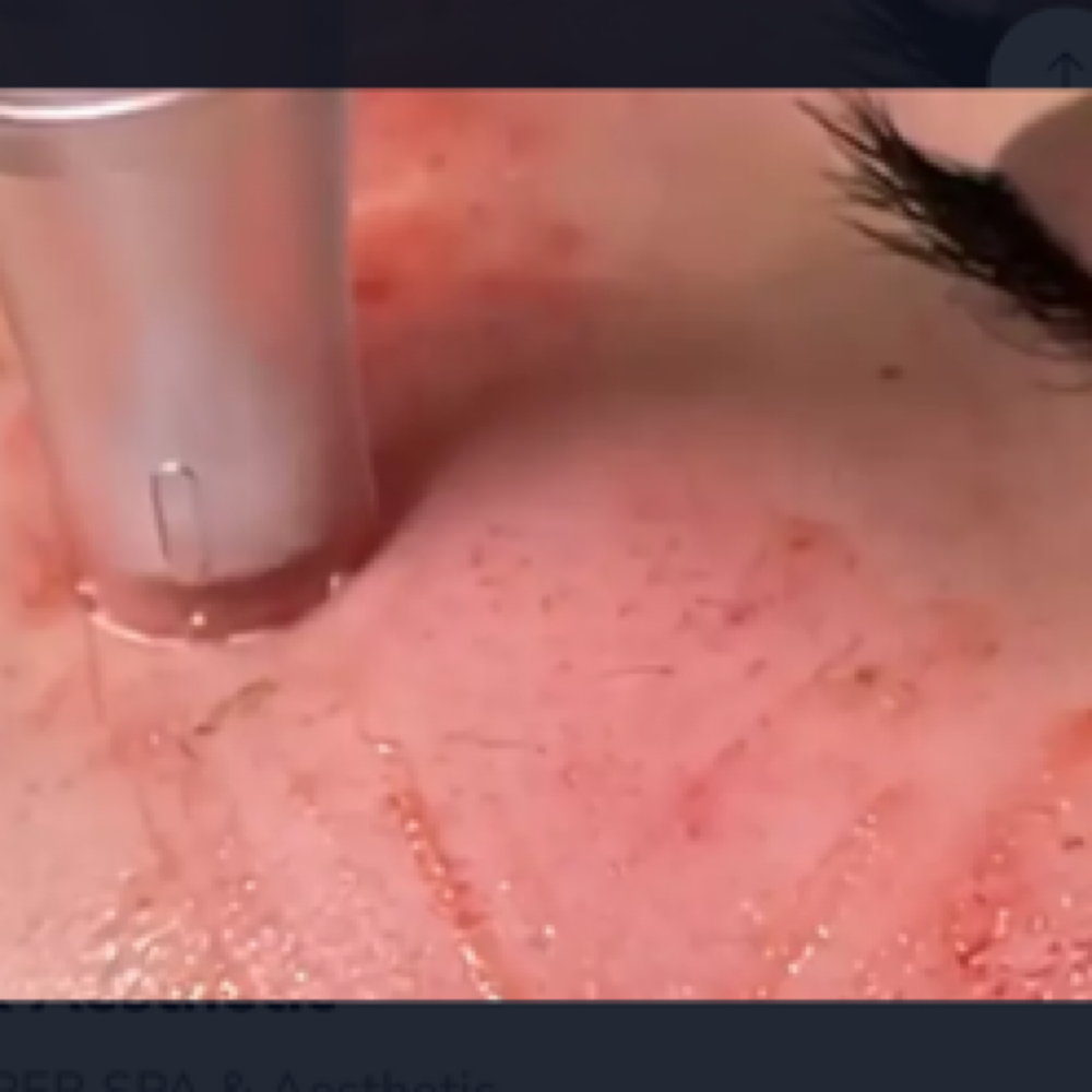 Microneedling with PRP at XKIN BEAUTY in McAllen, TX