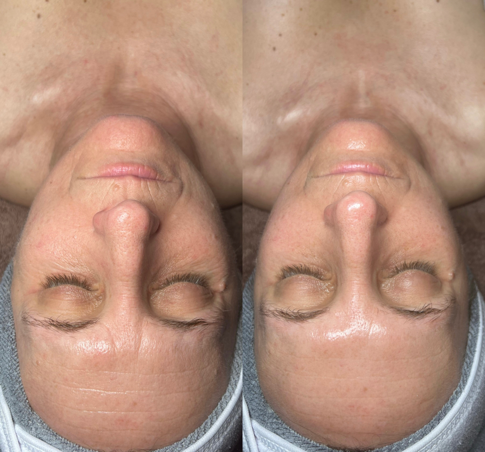 Age Renewal Facial