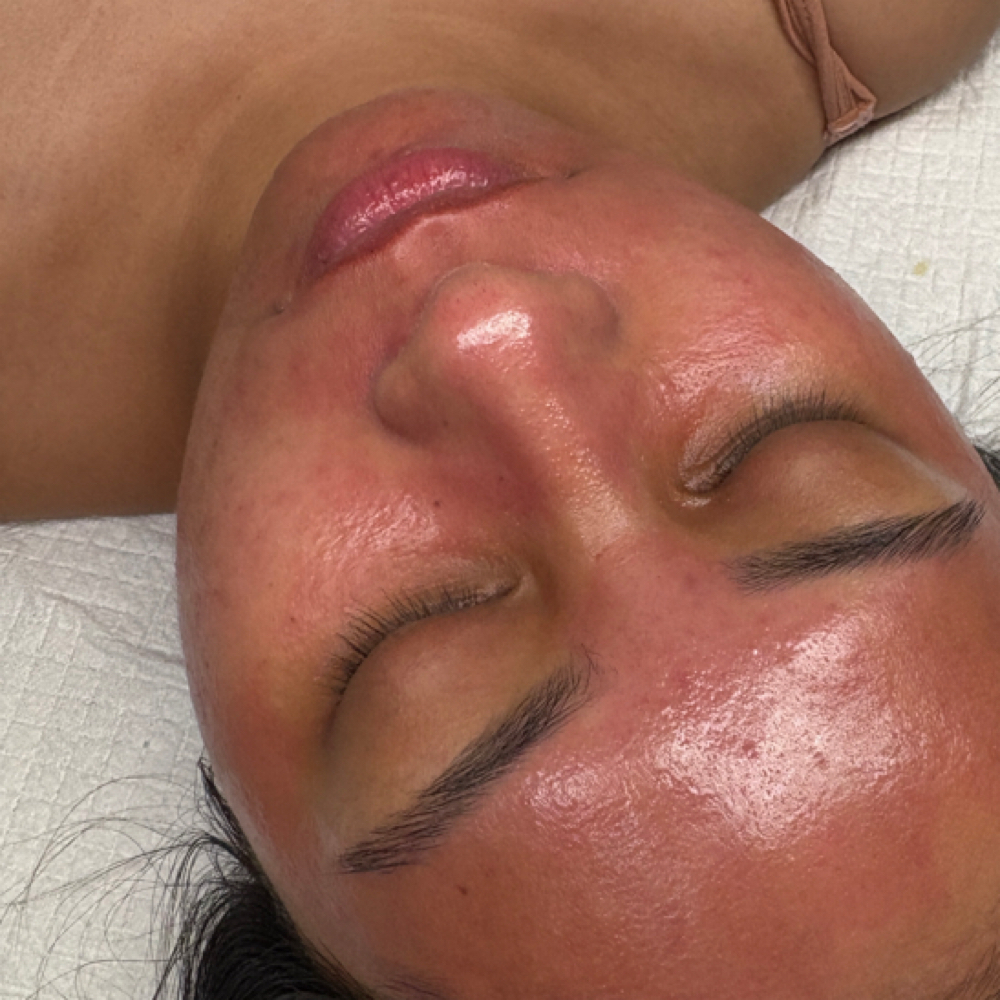 Microneedling