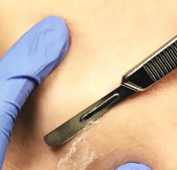 Dermaplaning With Facial at BELLA'S SENSES SPA by Angie in Coral Springs, FL