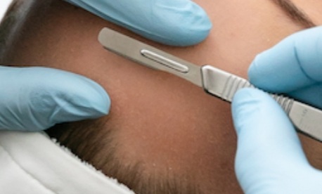 Dermaplaning Only at BELLA'S SENSES SPA by Angie in Coral Springs, FL