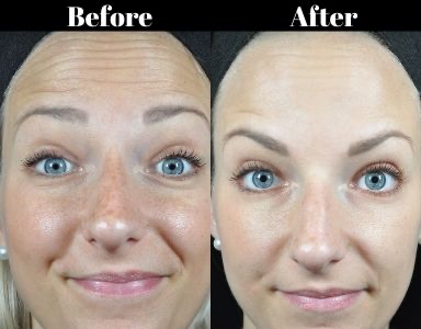 Hydra Stamp Facial