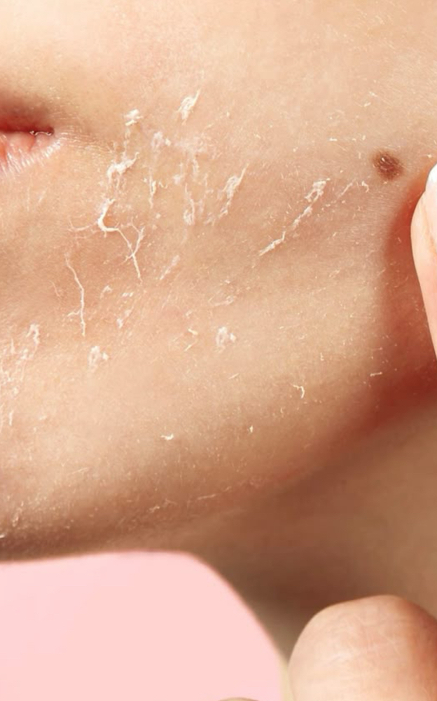 Chemical Peel