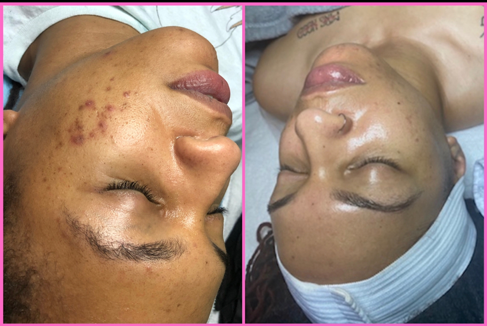 Dermaplane + Mini Peel (Salon)