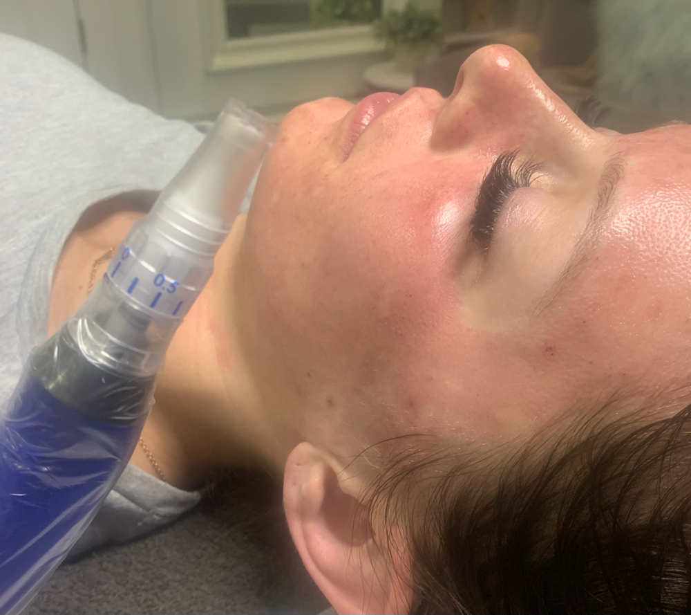 Micro Needling