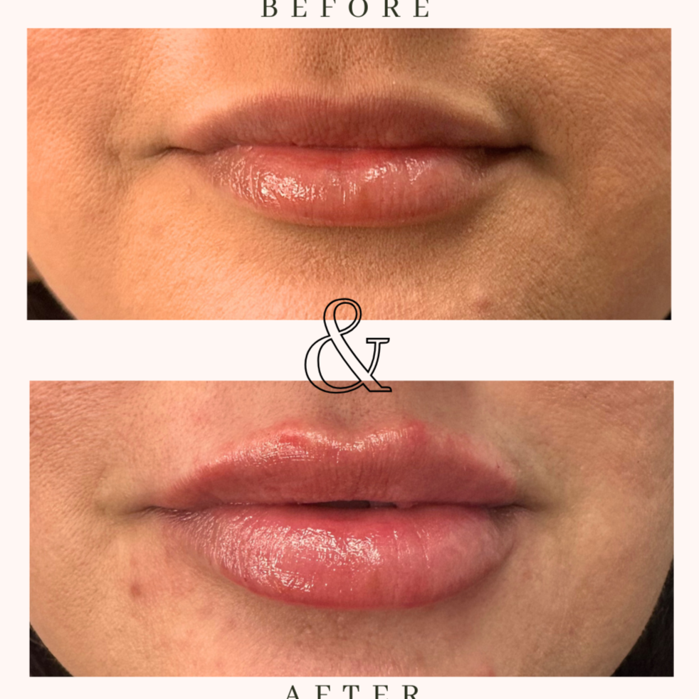 Blush Mini Plump (1/2 Syringe) at BLUSH Aesthetics LLC in Laredo, TX
