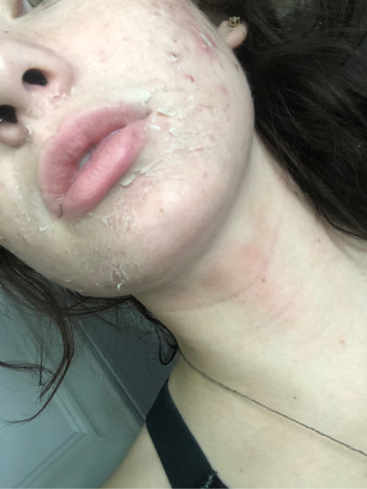 Chemical Peel TCA, Jessner