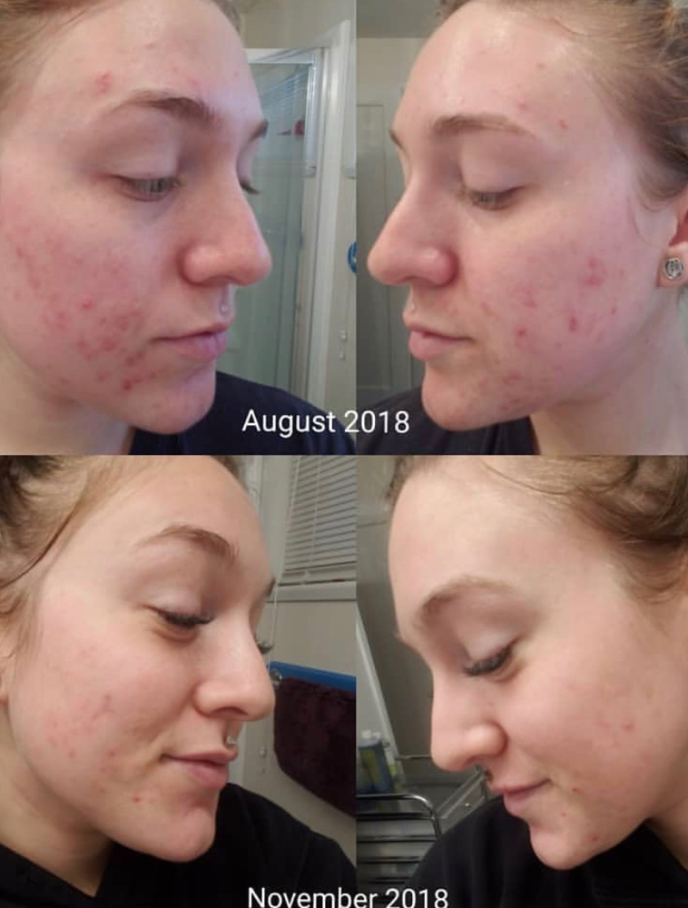 Acne Treatment
