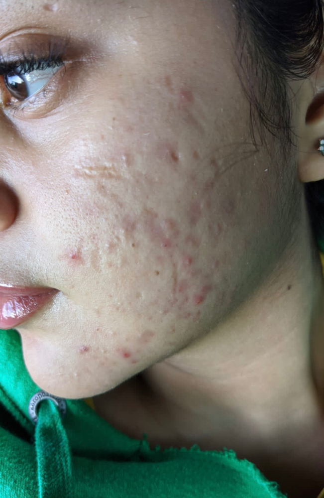 Microneedling Scars