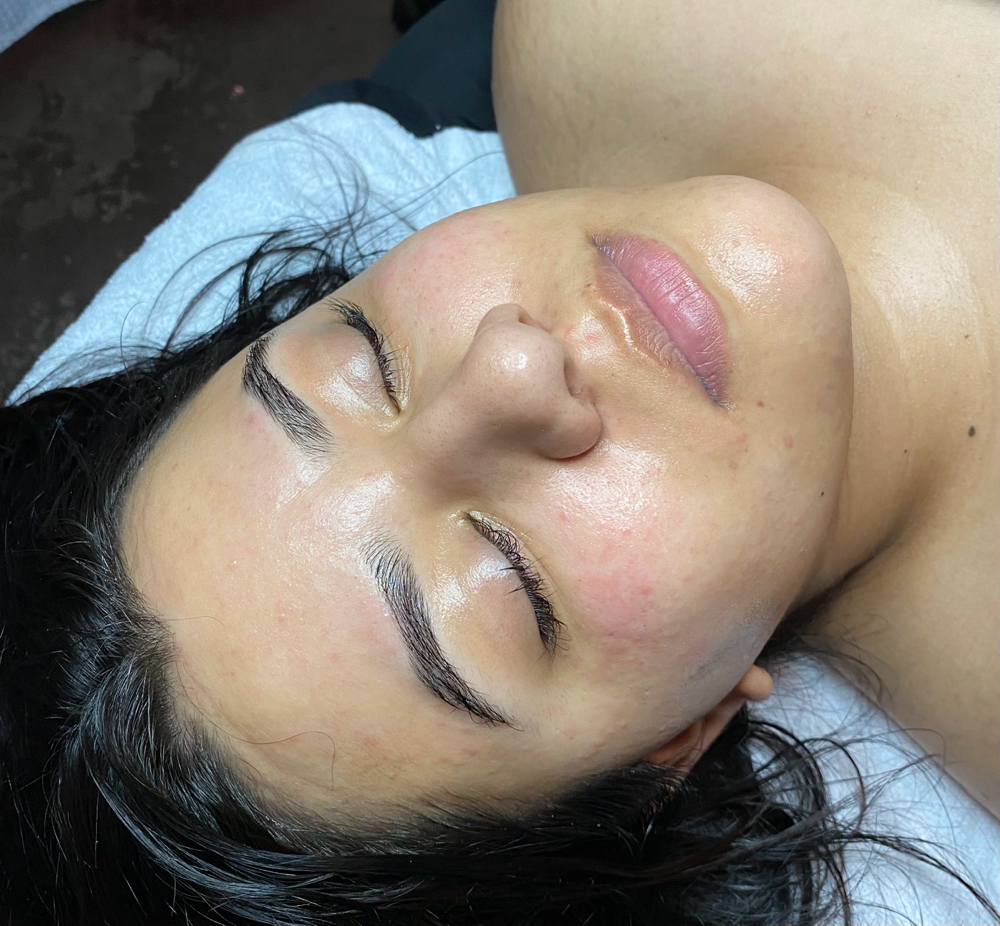 Facial With Dermaplane