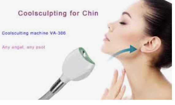 Chin Coolsculpting