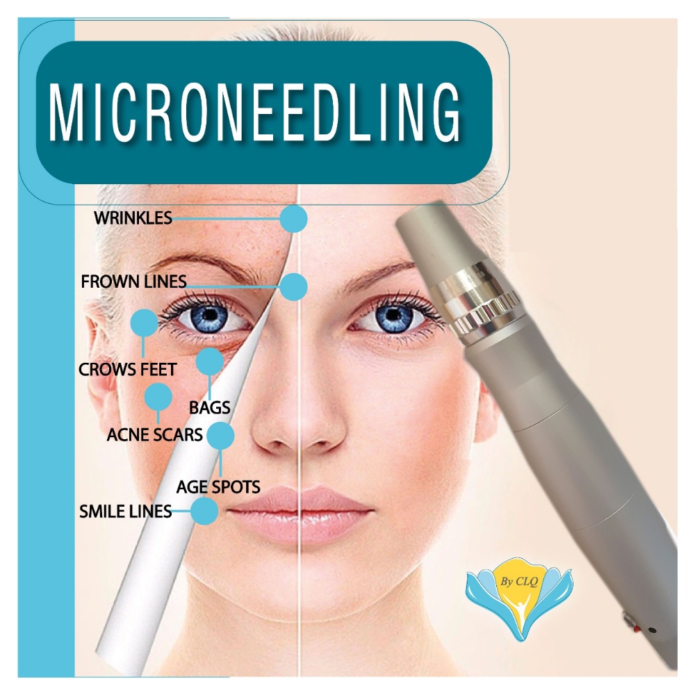 Microneedling (5 Sessions)