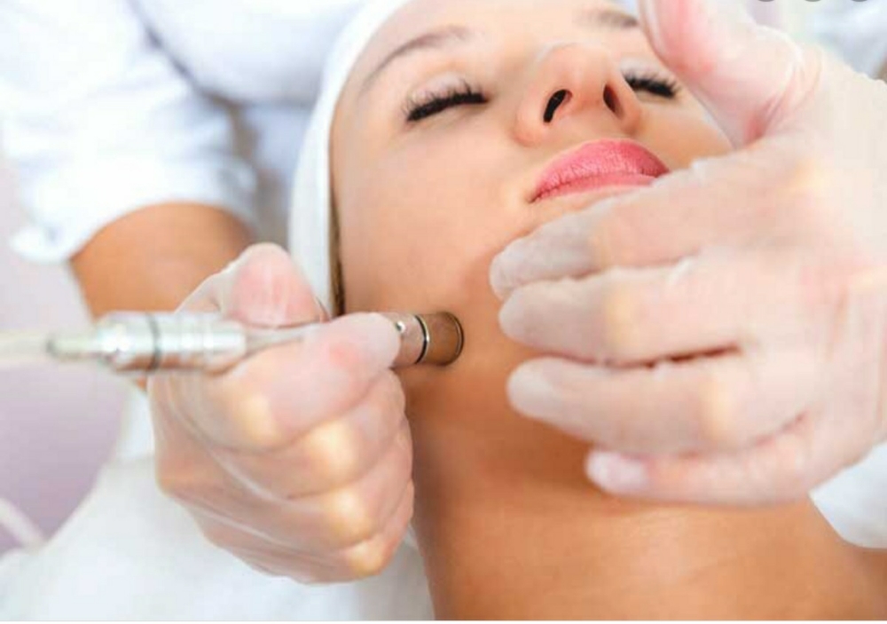 Microdermabrasion