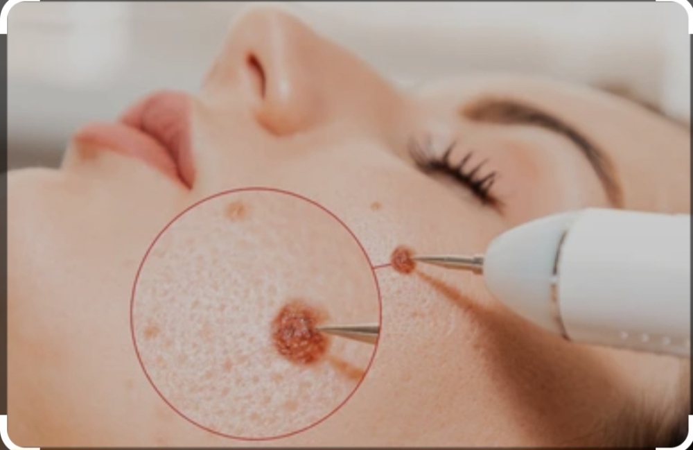 Laser pen mole/skin tag removal