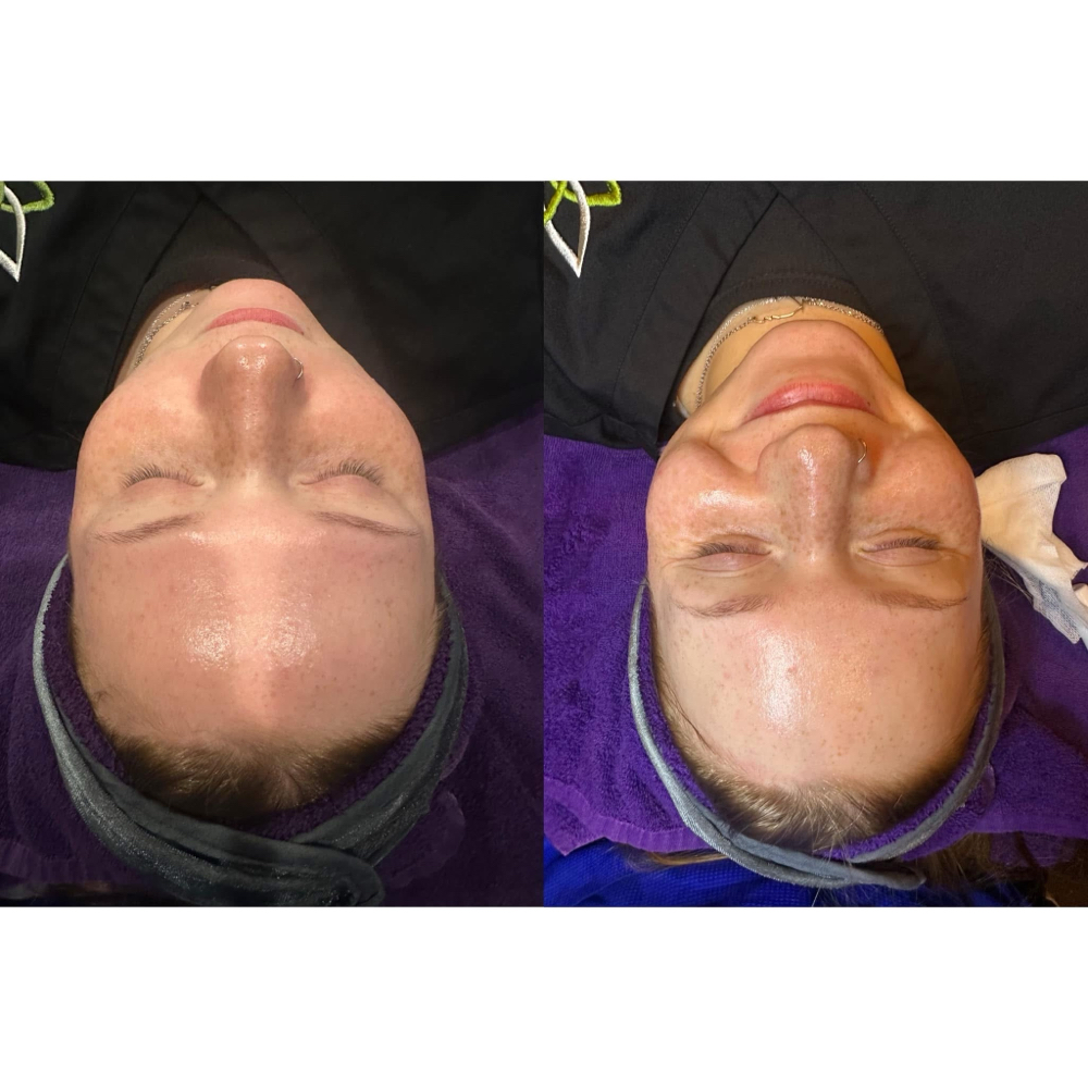 Microneedling Facial