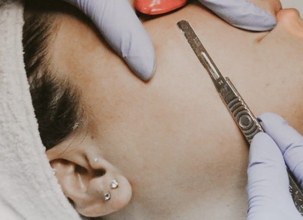 Dermaplanning