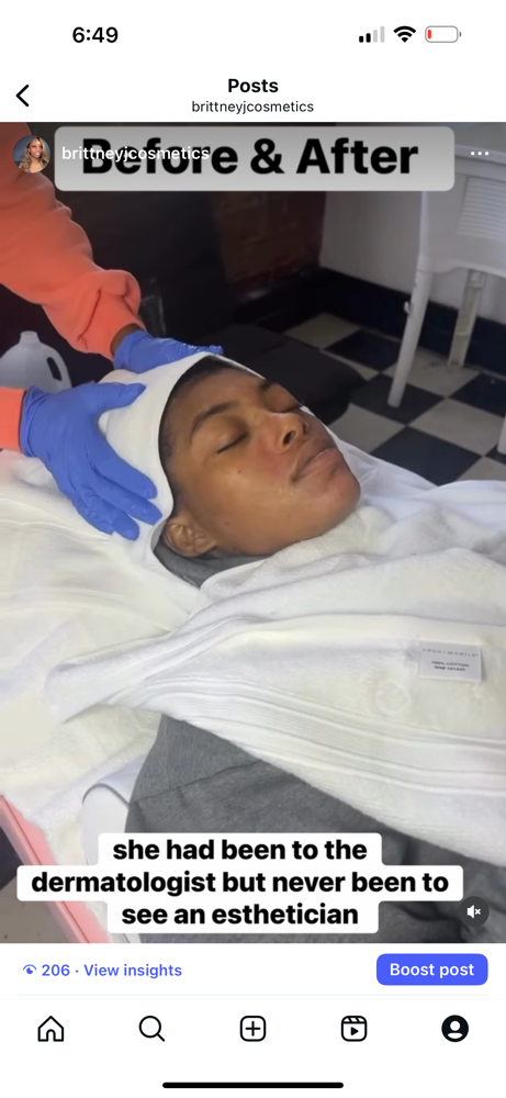 Eczema Facial