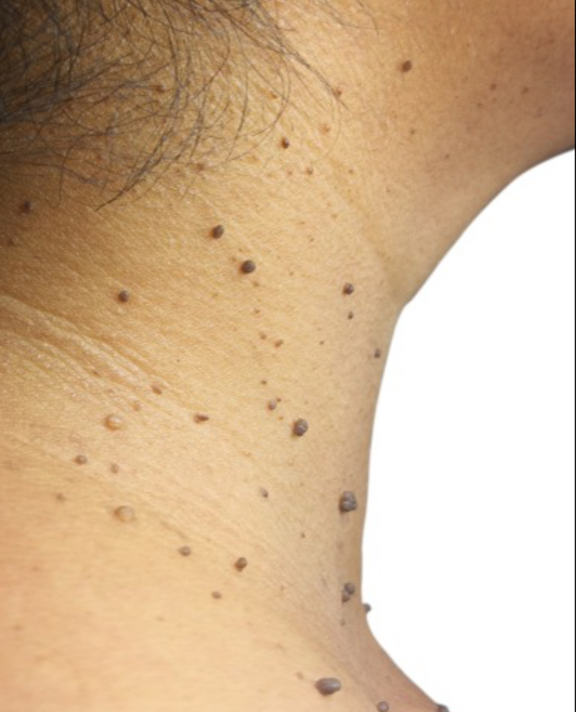 Skin Tag Removal at Nouvelle Vie Beauty in Cibolo, TX