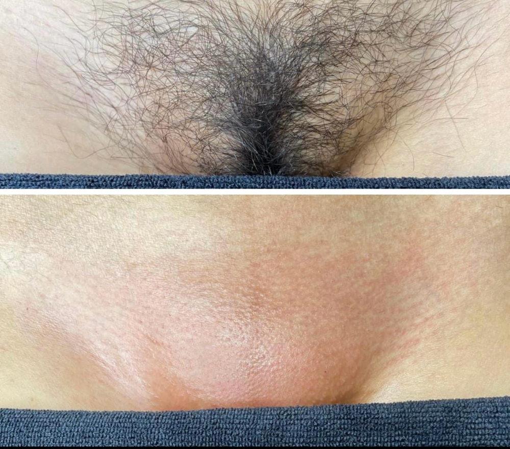 Full Brazilian Sugar Wax