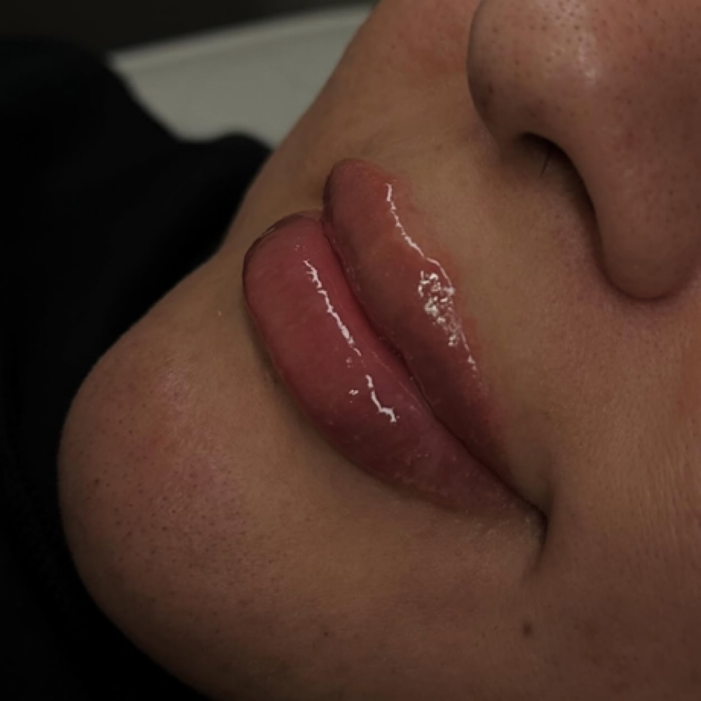 Lip Filler .7 ML at The Needle Studio Tx in Cleburne, TX