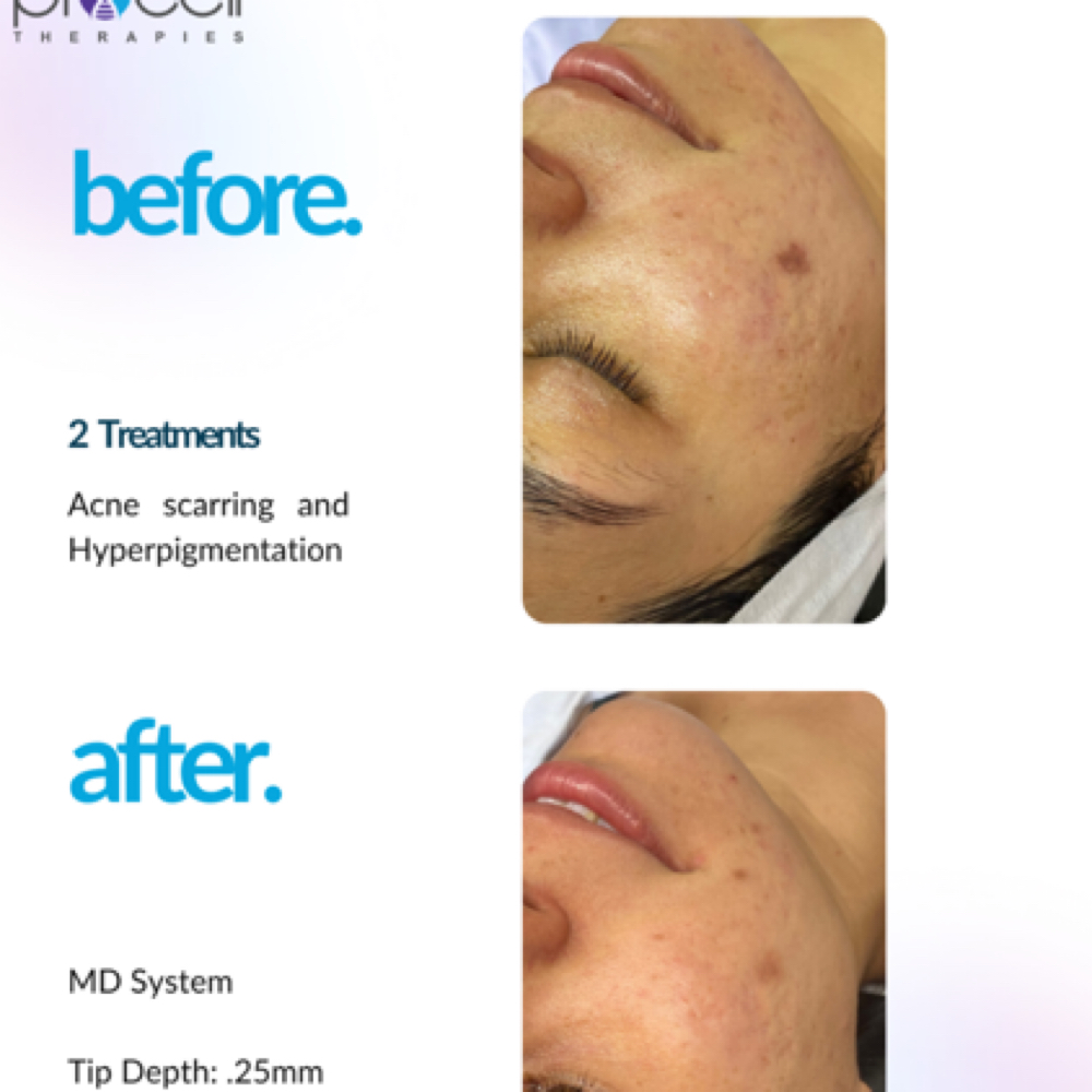 Full Face Package (3 sessions) at Altar Beauty Co. by Yury in Payette, ID