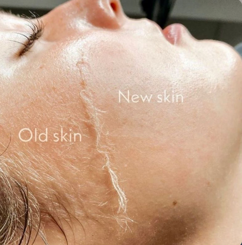 Dermaplaning Facial ✨ at Veraē Esthetics in Shorewood, WI