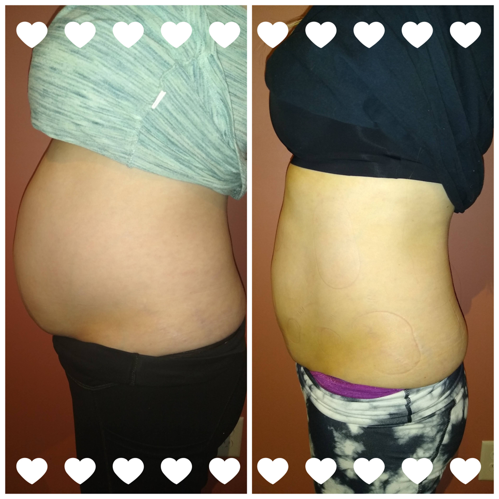 Lipo Shots/Infusions