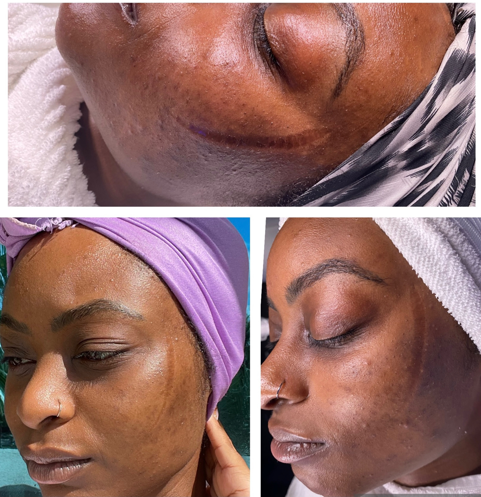 Microchanneling For Acne Prone Skin at Beauty Therapy by Chanel in Tucker, GA