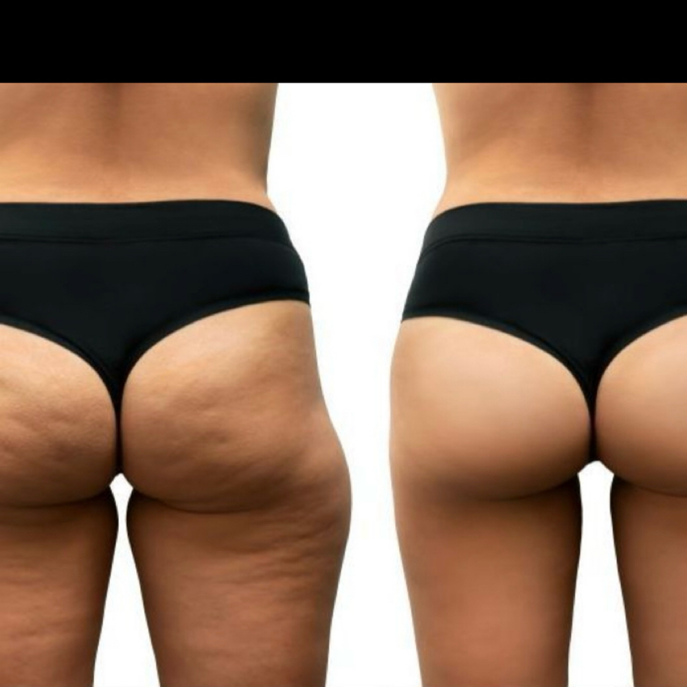 Cellulite removal