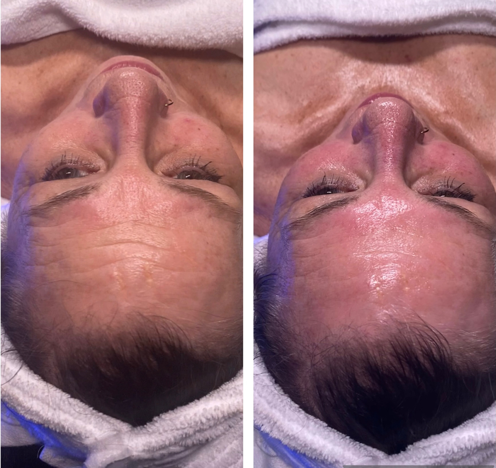 Tighten My Skin at Beauty Therapy by Chanel in Tucker, GA