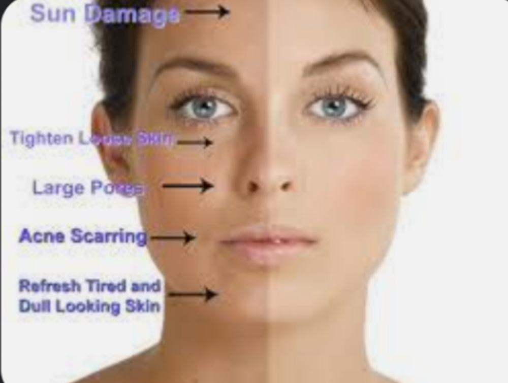 Superficial Chemical Peel