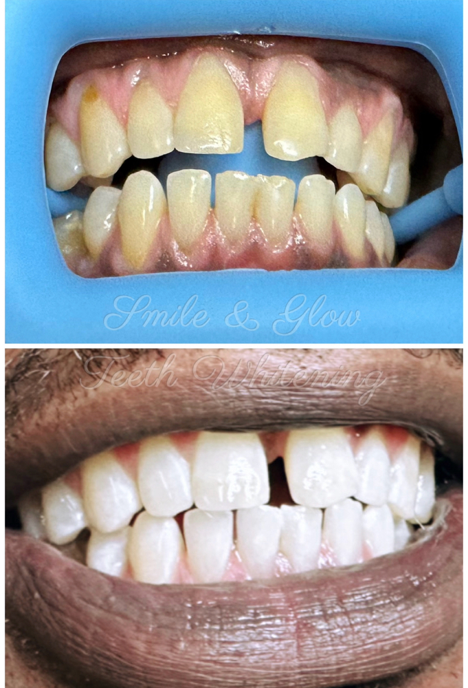 Teeth Whitening (Max)