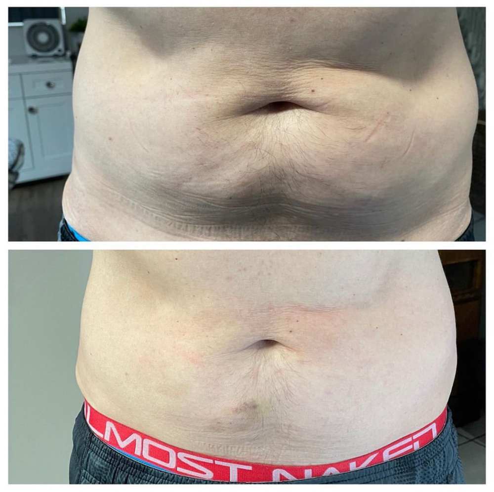 Stomach  Fat Dissolvers