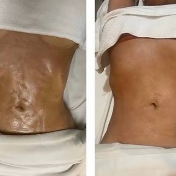 Fibrosis Corrective Treatment