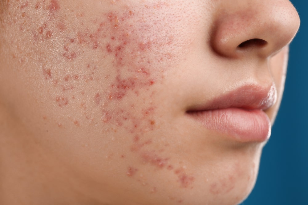 Acne Salicylic 30% Peel Package