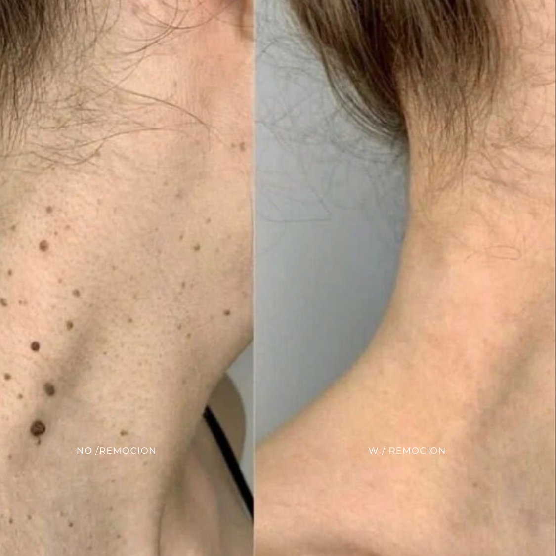 REMOCION DE MILIAS Y VERRUGAS at EROXSPA in Houston, TX