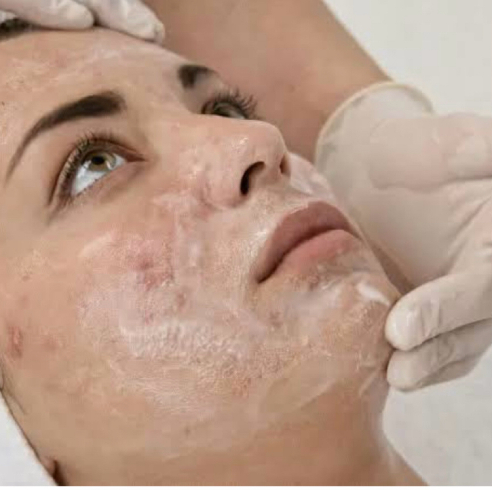 Acne Facial Treatment at Gardenias Beauty Salon in North Charleston, SC