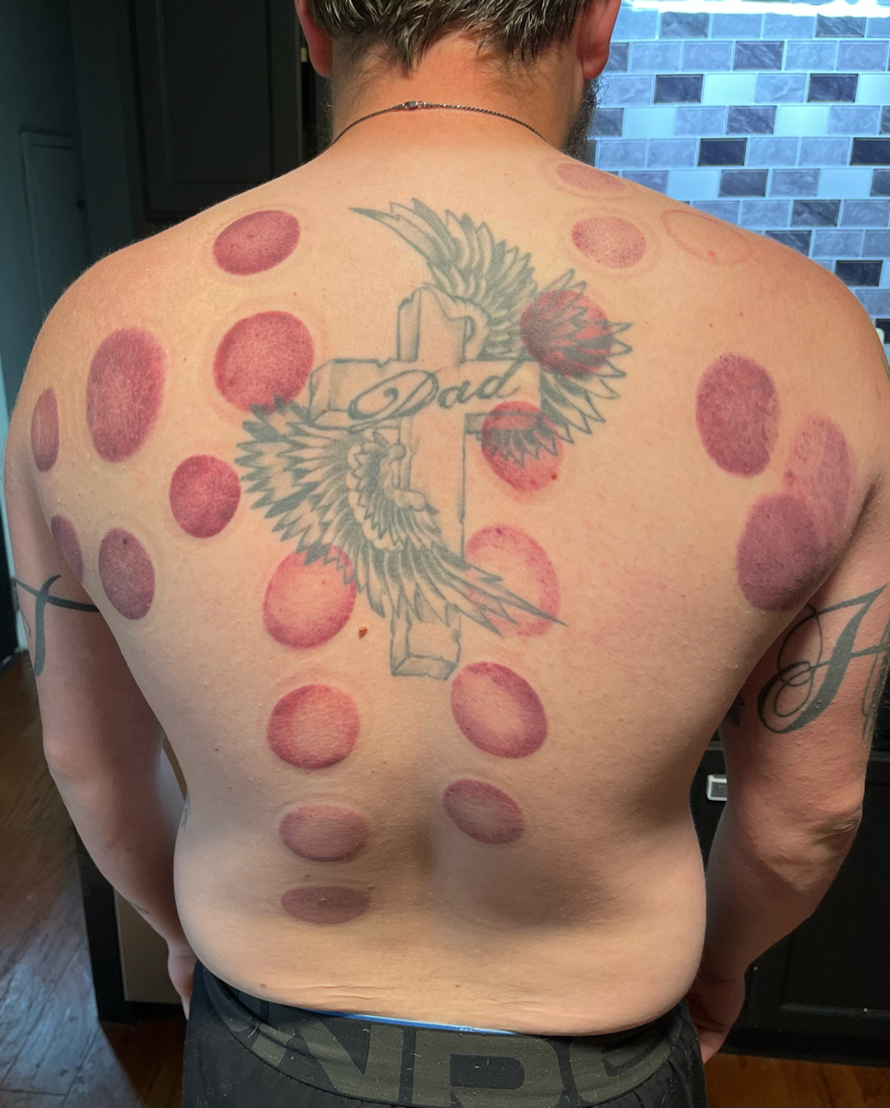 Cupping Therapy
