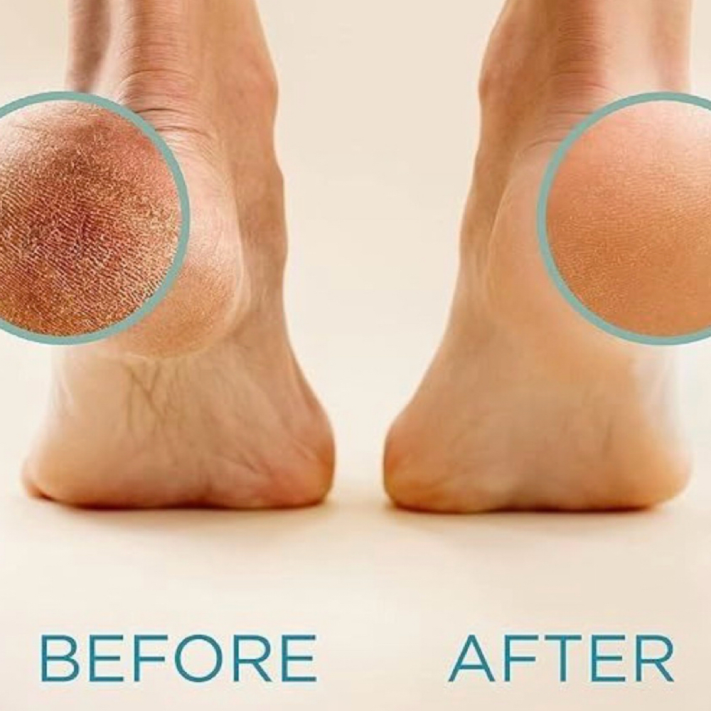 Callous at Prestige bliss in Maspeth, NY