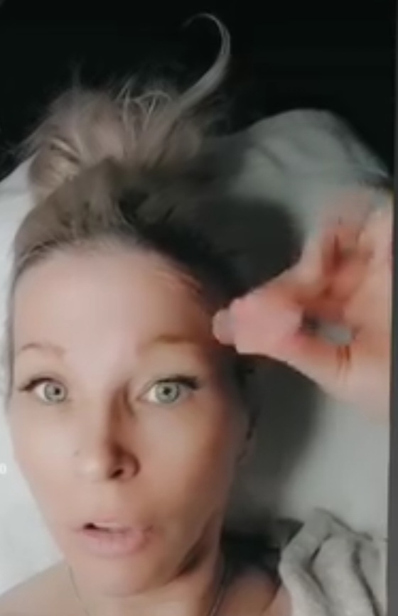 Facial Cupping