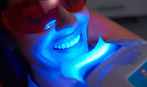 Teeth Whitening Extended Session