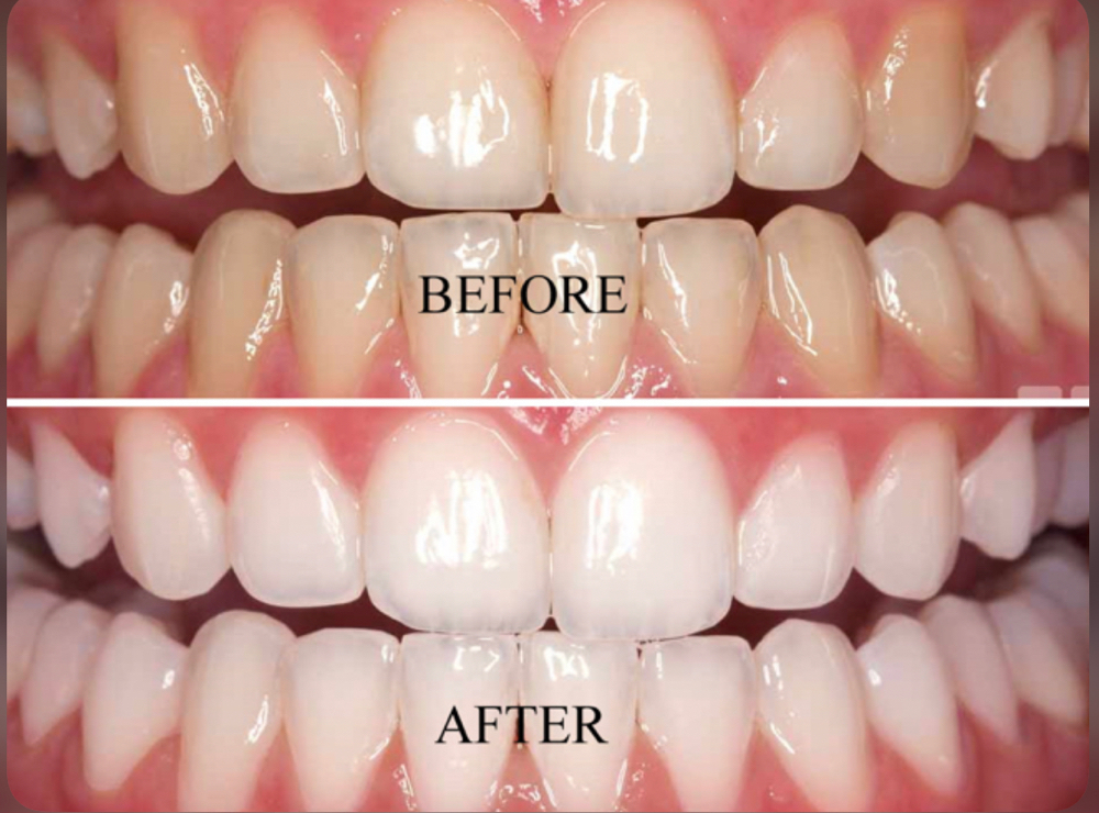 Teeth Whitening